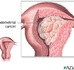 endometrial-cancer.JPG